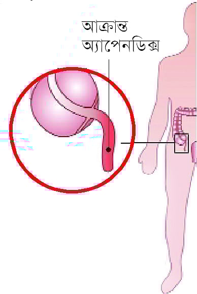তলপেটে ব্যথা মানেই অ্যাপেনডিসাইটিস?