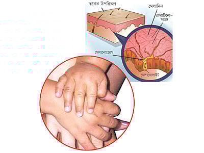 মেলানিনই ঠিক করে কার গায়ের রং কেমন হবে। মেলানিনের মাত্রা নির্ভর করে জাতিসত্তা, বংশগতি, সূর্যালোকের উপস্থিতির ওপর। মেলানিন বেড়ে গেলে ত্বকের রং গাঢ় বা কালো হয়ে যায়, আবার মেলানিন অস্বাভাবিক কমে গেলে রং ফ্যাকাশে সাদা হয়ে যায়