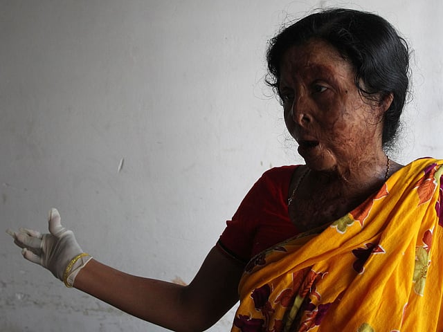 দুর্ঘটনায় পুড়ে গিয়েছিল মণি বিবির মুখ-হাত। পোড়ার যন্ত্রণা তাই ভালো করেই বুঝেন তিনি। সেই উপলব্ধি থেকে এখন কাজ করছেন ঢাকা মেডিকেল কলেজ হাসপাতালের বার্ন ইউনিটে, বিনা বেতনে। ছবি: মনিরুল আলম