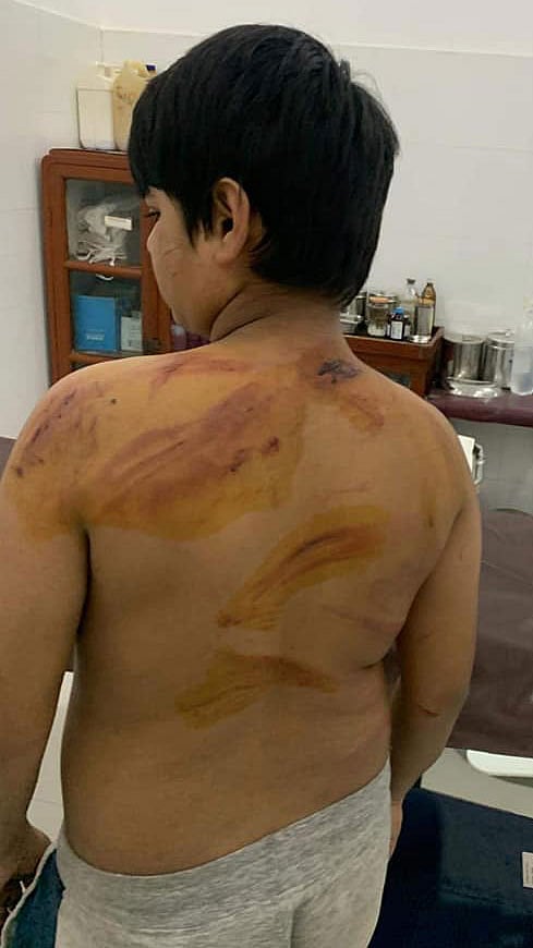 সারা শরীরের বিভিন্ন জায়গায় নির্যাতনের ভয়াবহ চিহ্ন। নির্মম এই নির্যাতনের শিকার হয়েছেন রাজধানীর ১১ বছরের এক শিশু। নির্যাতক ছেলেটির বাবা। ছবি : ফেসবুক থেকে নেওয়া