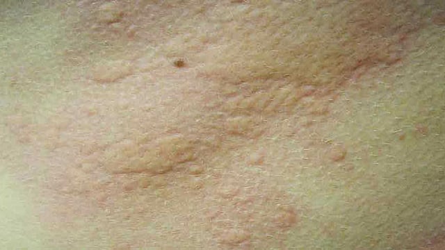 অ্যালার্জির কারণে শরীরের বিভিন্ন জায়গায় গোটা গোটা বা চাকা চাকা হয়ে যেতে পারে। ছবি: সংগৃহীত