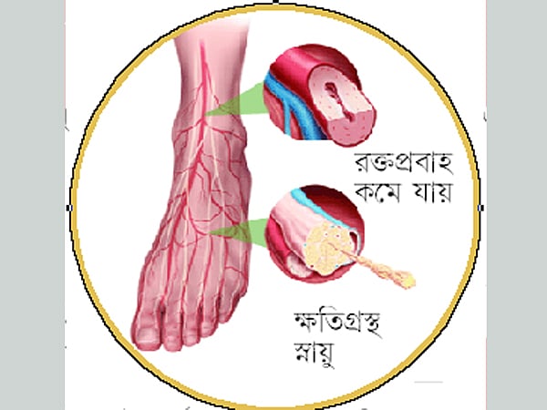 পায়ে জ্বালাপোড়া