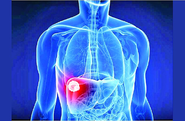 যকৃতেও ফোড়া হয়