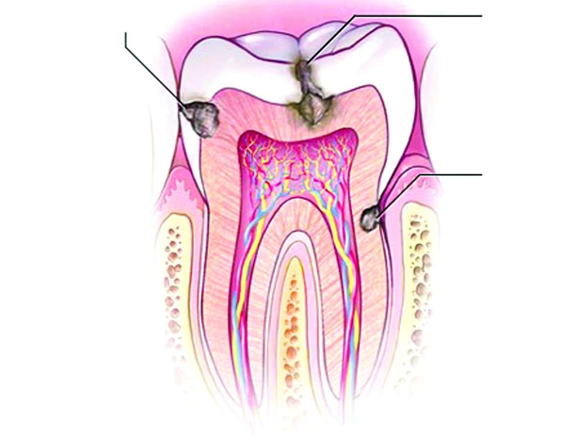 দাঁতের ক্ষয় বা গর্ত হওয়াকে অনেকেই দাঁতের পোকা বলে