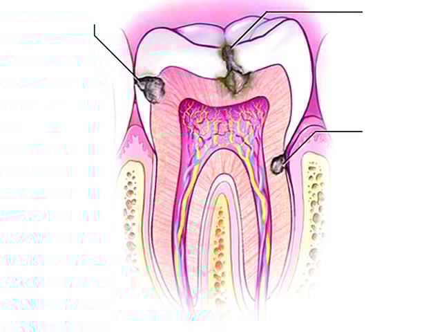 দাঁতের ক্ষয় বা গর্ত হওয়াকে অনেকেই দাঁতের পোকা বলে
