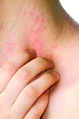 অ্যালার্জি