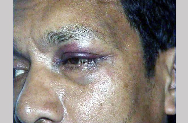 কুষ্টিয়ায় সাংসদের ভাইয়ের ক্যাডারদের হাতে মারধরের শিকার হওয়ার পর ইউপি সদস্য আশরাফুল ইসলামের চোখের ওপর রক্ত জমাট বেঁধেছে। ছবি: প্রথম আলো