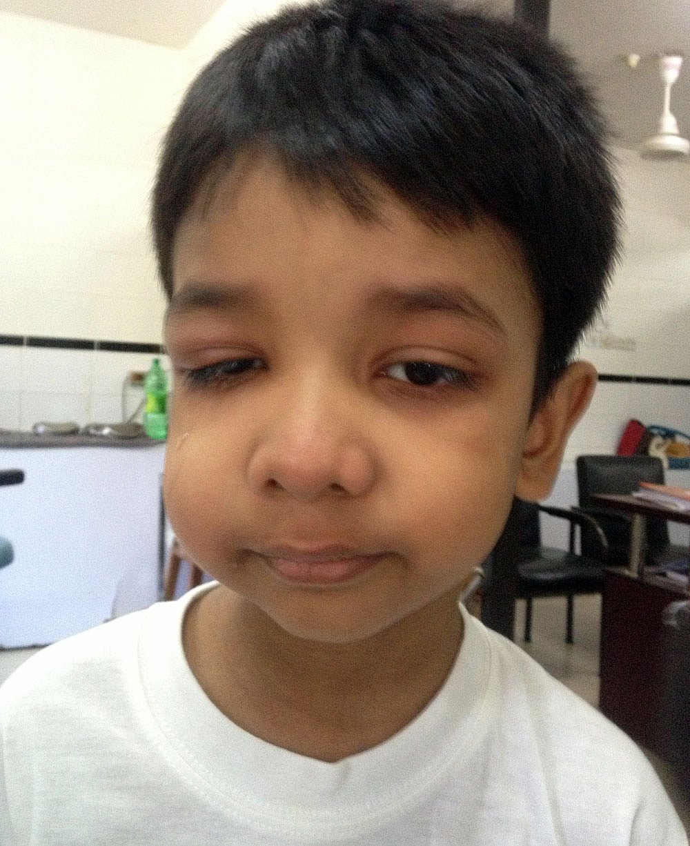 সাধারণত ছয় থেকে ১০ বছরের শিশুদের দুধদাঁতে এ রোগ বেশি হয়ে থাকে। শিশুরা চকলেট, জুস ও মিষ্টিজাতীয় খাবার খেলে ঠিকমতো মুখ পরিষ্কার করতে হবে। রোগাক্রান্ত শিশুর ছবিটি ডেন্টাল সার্জন ঈষিকা নাজনীনের তোলা।