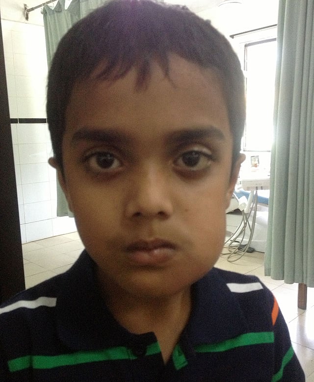 ব্যথা বেশি হলে ব্যথার সামান্য ওষুধ খাওয়া যেতে পারে এবং হালকা গরম পানিতে লবণ দিয়ে কুলি করলে ব্যথা কিছুটা প্রশমন হতে পারে। রোগাক্রান্ত শিশুর ছবিটি ডেন্টাল সার্জন ঈষিকা নাজনীনের তোলা।