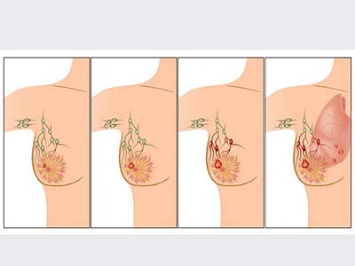 স্তন ক্যানসারের ধাপসমূহ। ছবি: অর্গানিক হেলথ ডটকম