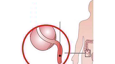 উপকারী ব্যাকটেরিয়ার নিরাপদ আবাস হিসেবে কাজ করে অ্যাপেন্ডিক্স