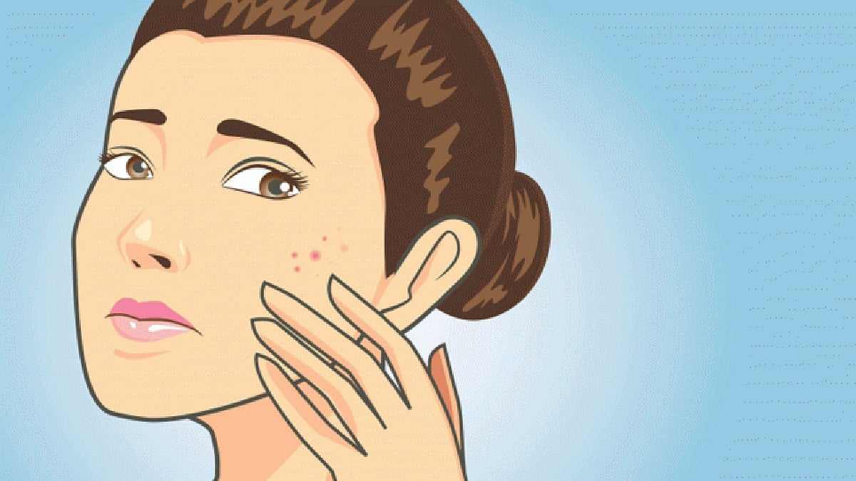 ব্রণ না খোঁটানোই ভালো। এতে ত্বক ভালো থাকে, ব্রণও ছড়ায় না। ছবি: সংগৃহীত