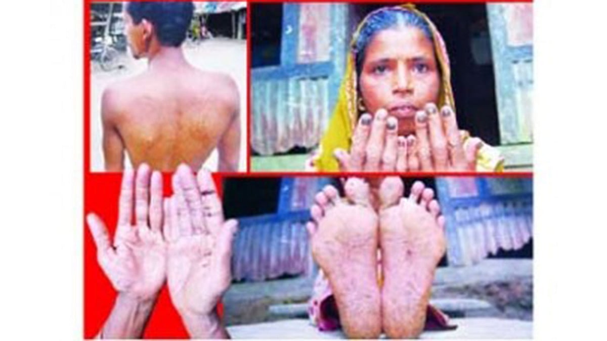 আর্সেনিকে আক্রান্তদের রক্ষায় যুগান্তকারী আবিষ্কার