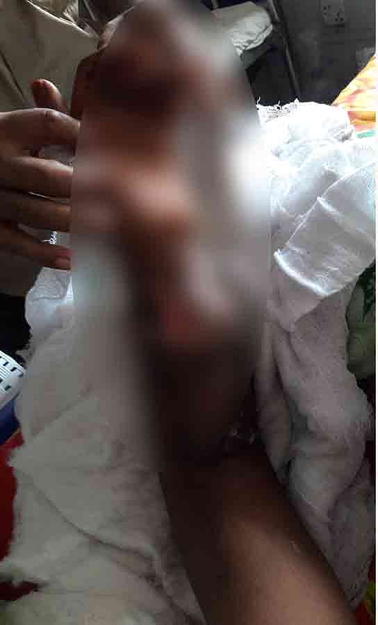 বার্ন অ্যান্ড প্লাস্টিক সার্জারি ইউনিটে অঙ্গ জোড়া লাগানোর অস্ত্রোপচারের ক্ষেত্রে সফলতার হার ৫০ শতাংশ। ছবি: সংগৃহীত