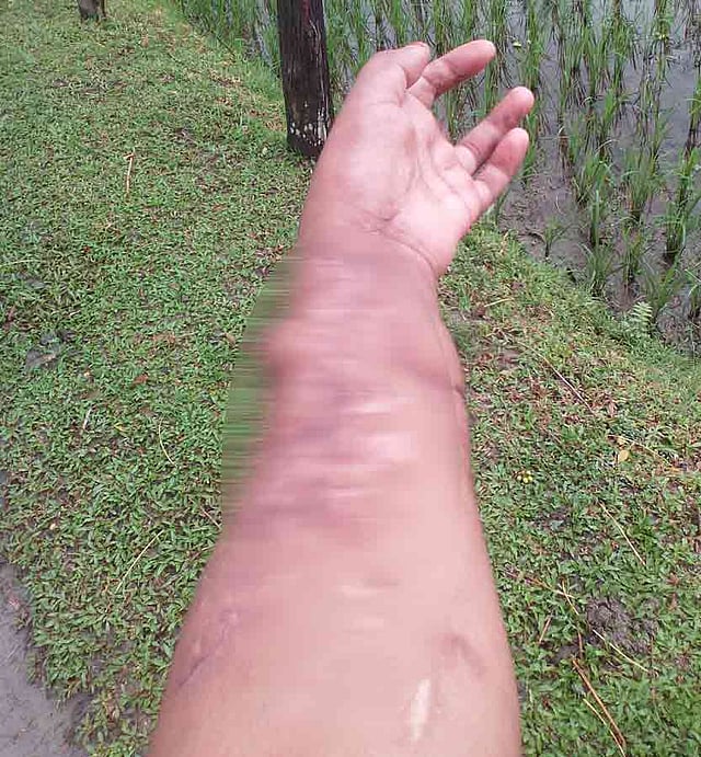 ঢাকা মেডিকেল কলেজ হাসপাতালে ৯ বছরে ১৭টি কাটা আঙুল ও ১০টি কাটা হাত বা পা জোড়া লাগানো হয়েছে। ছবি: সংগৃহীত