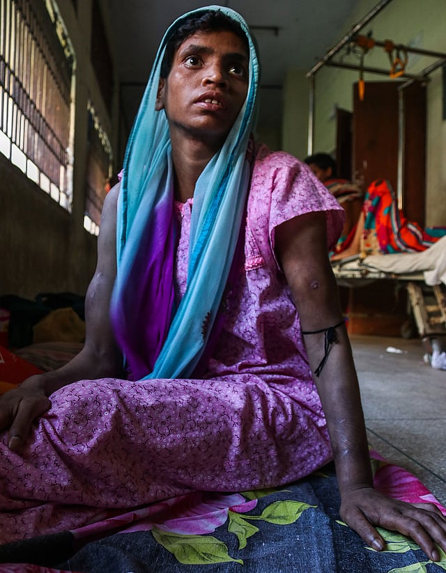 শরীরজুড়ে ক্ষতচিহ্ন নিয়ে খুলনা মেডিকেল কলেজ হাসপাতালের বারান্দায় চিকিৎসা নিচ্ছেন সাবিনা খাতুন (২৫)। দুই চোখে তাঁর এখনো আতঙ্ক ও ভয়। গতকালের ছবি। প্রথম আলো