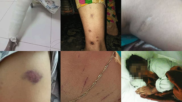 সৌদি-ফেরত নারী কর্মীদের শরীরে নির্যাতনের ক্ষত। ছবি: সংগৃহীত