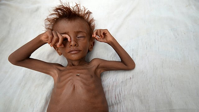 সৌদি অবরোধে দুর্ভিক্ষ ও মহামারিও নিয়ে নিচ্ছে শিশুদের। ছবি: এএফপি