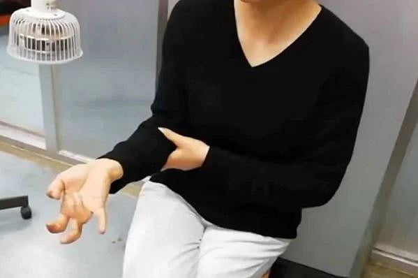 একনাগাড়ে মোবাইল স্ক্রলিং করার কারণে এভাবেই হাতের আঙুল বেঁকে যায় চীনা নারীর। ছবি: সামাজিক যোগাযোগমাধ্যম থেকে নেওয়া