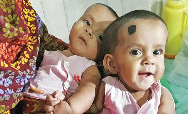অস্ত্রোপচারের আগে তোফা-তহুরা। তারা পিঠ থেকে কোমরের নিচ পর্যন্ত পরস্পর সংযুক্ত ছিল। ছবি: মানসুরা হোসাইন