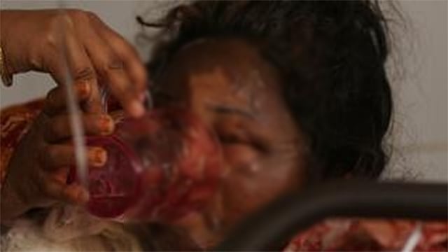 হাসপাতালের বিছানায় যন্ত্রণায় কাতরাচ্ছেন তাসলিমা। বার্ন ইউনিউট, ঢাকা মেডিকেল কলেজ হাসপাতাল, ২৩ জানুয়ারি। ছবি: আবদুস সালাম