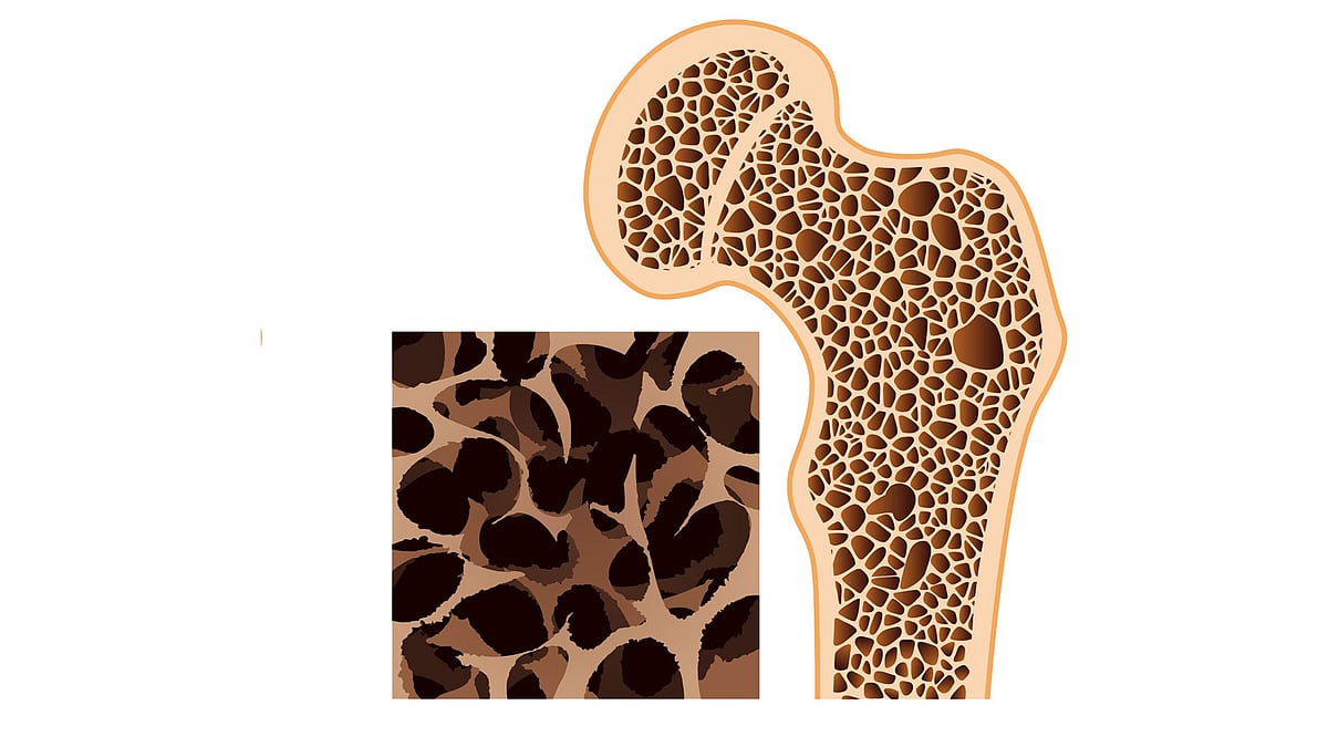 হাড়ক্ষয়