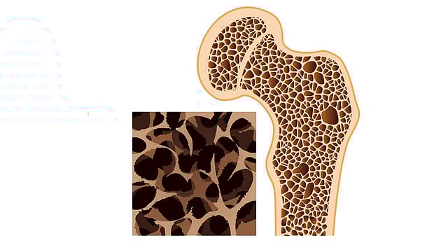 হাড়ক্ষয়
