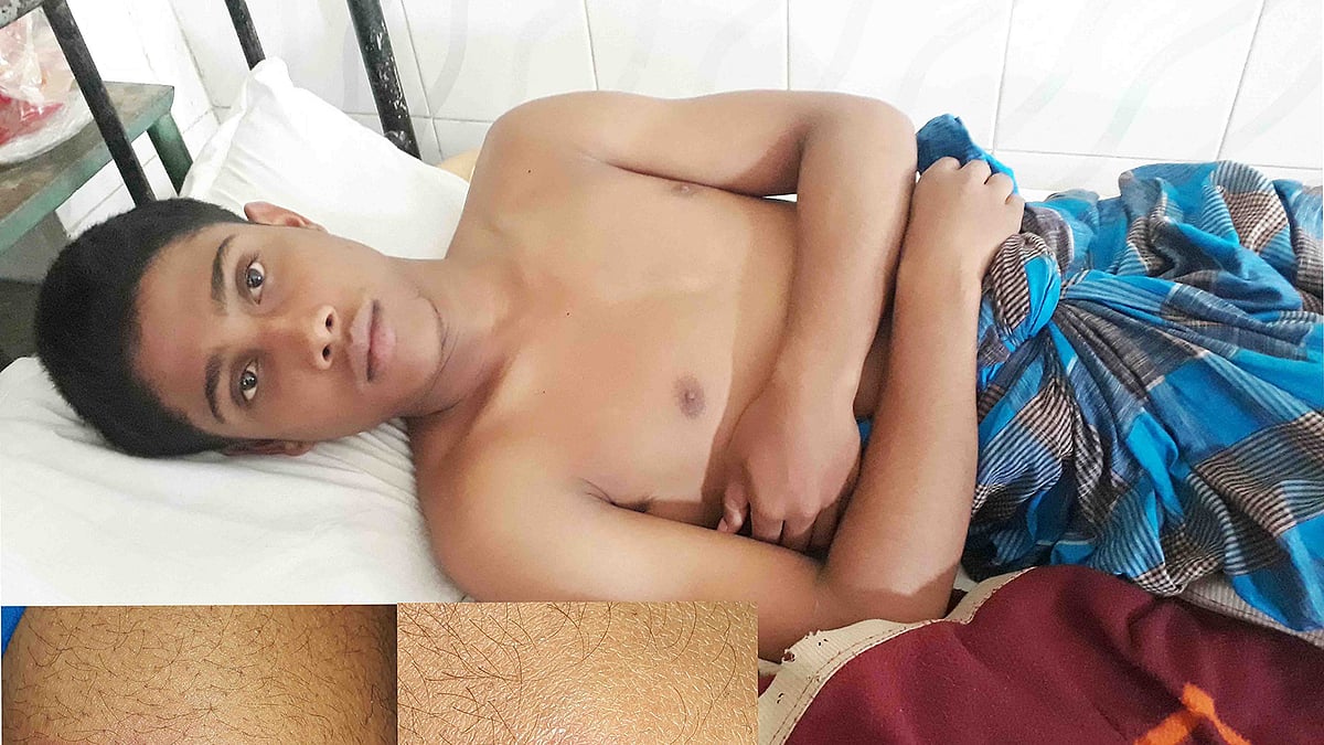 উপজেলা স্বাস্থ্য কমপ্লেক্সে চিকিৎসাধীন শিক্ষার্থী রাশিদুল। সিংড়া, নাটোর। ছবি: প্রথম আলো