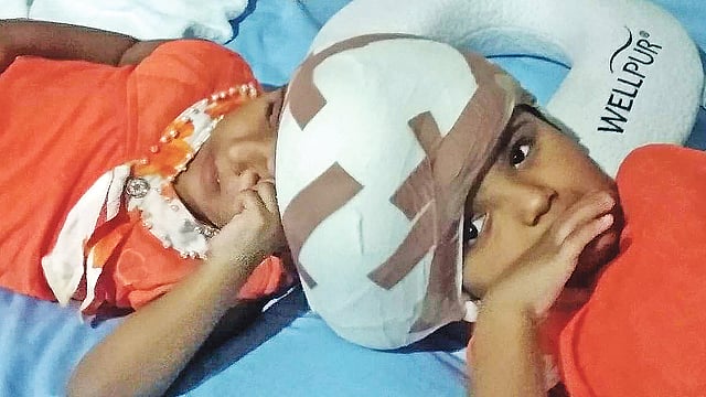 অস্ত্রোপচারের পর মাথা জোড়া লাগানো যমজ শিশু রাবেয়া ও রোকাইয়া।  ছবি: আইএসপিআর
