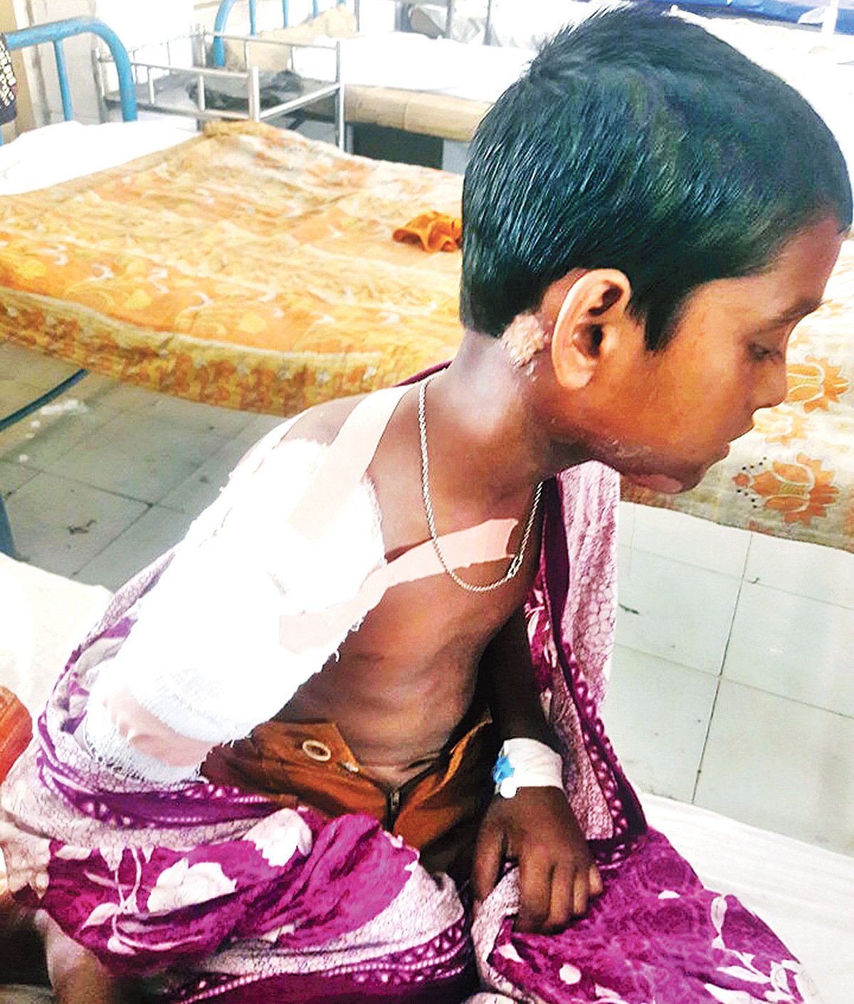 ফুটন্ত দুধে দগ্ধ শিশু সিয়াম।  ছবি: প্রথম আলো