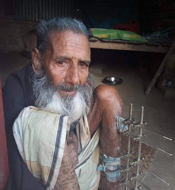 প্রায় সাত মাস আগে একটি দুর্ঘটনায় পায়ের হাড় ভেঙে যায় বৃদ্ধ কুদ্দুসের। পরে অস্ত্রোপচারের মাধ্যমে ওই স্থানে রড লাগানো হয়। ছবি: সংগৃহীত