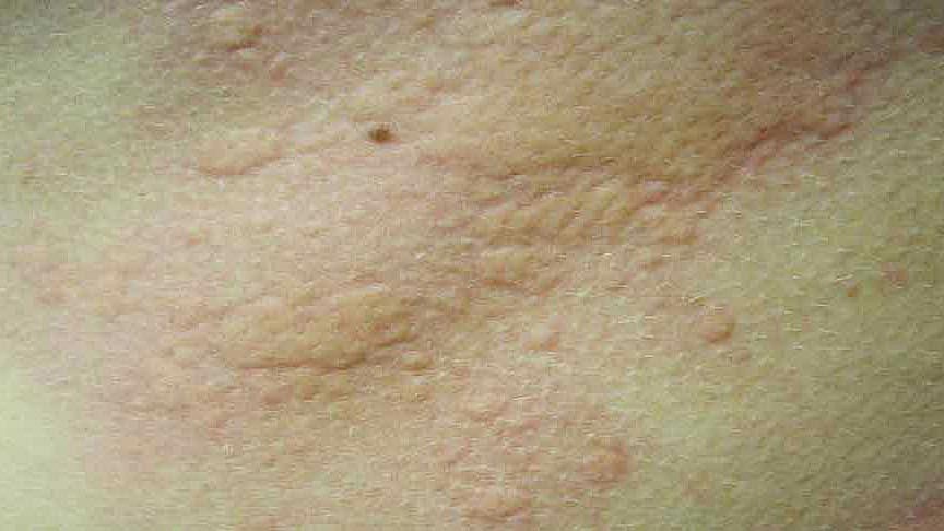 অ্যালার্জির কারণে শরীরের বিভিন্ন জায়গায় গোটা গোটা বা চাকা চাকা হয়ে যেতে পারে। ছবি: সংগৃহীত