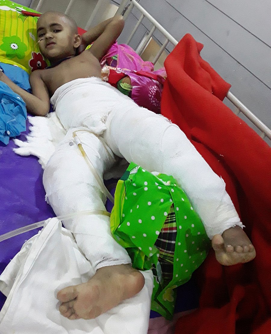 ঢাকা মেডিকেল কলেজ হাসপাতালের বার্ন ও প্লাস্টিক সার্জারি ইউনিটে চিকিৎসাধীন শিশু সিনথিয়া। ছবি: সংগৃহীত