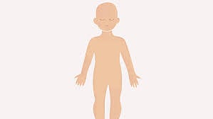 সেরিব্রাল পালসি আক্রান্ত শিশুর চিকিৎসা