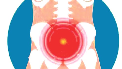 হার্নিয়াতে চিকিৎসা না করালে নানা ধরনের জটিলতা হতে পারে।