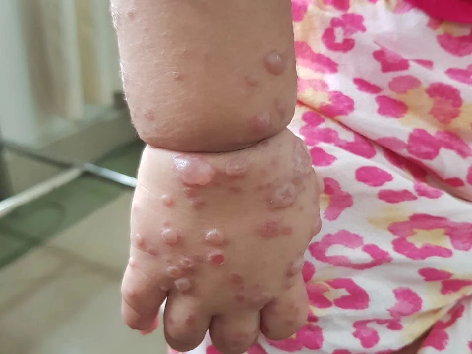 prothomalo-bangla%2F2022-09%2F060aad6d-6f7b-40ea-98cc-2565bb66c68d%2FHand_foot_mouth_1.jpg?w=1536&auto=format%2Ccompress&fmt=webp