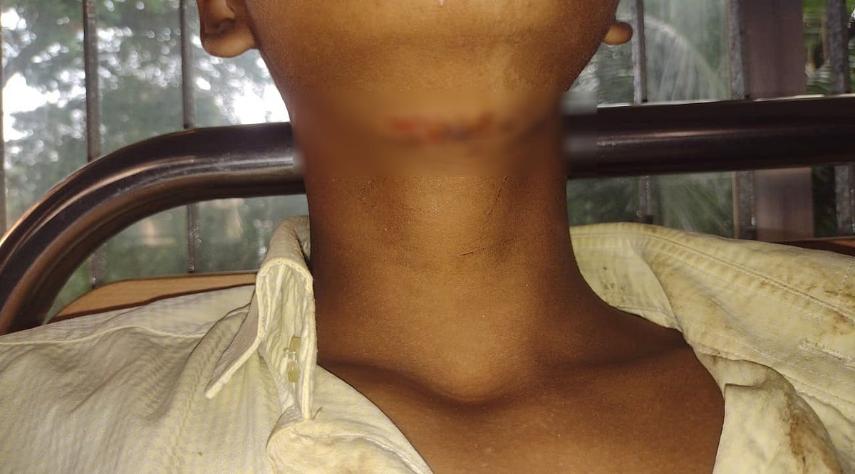 কিশোরের গলায় ক্ষত সৃষ্টি হয়েছে। সে পলাশ উপজেলা স্বাস্থ্য কমপ্লেক্সে চিকিৎসাধীন