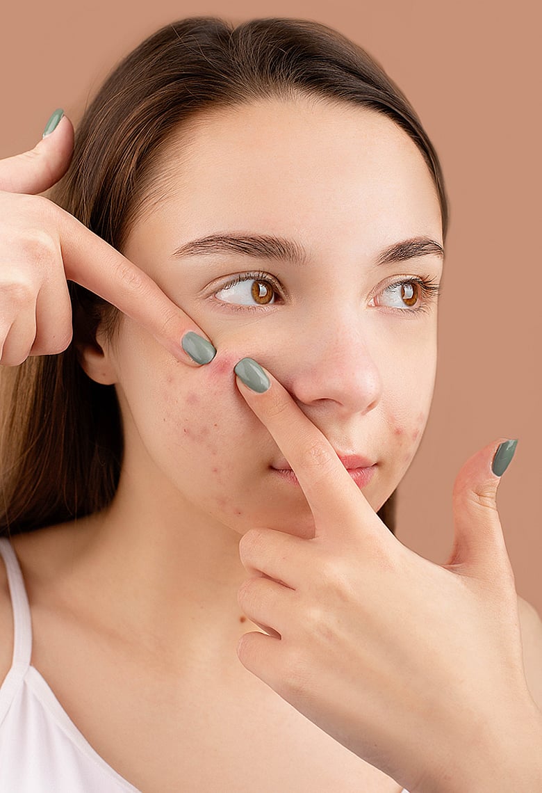 গরমে ব্রণ প্রতিরোধের উপায়