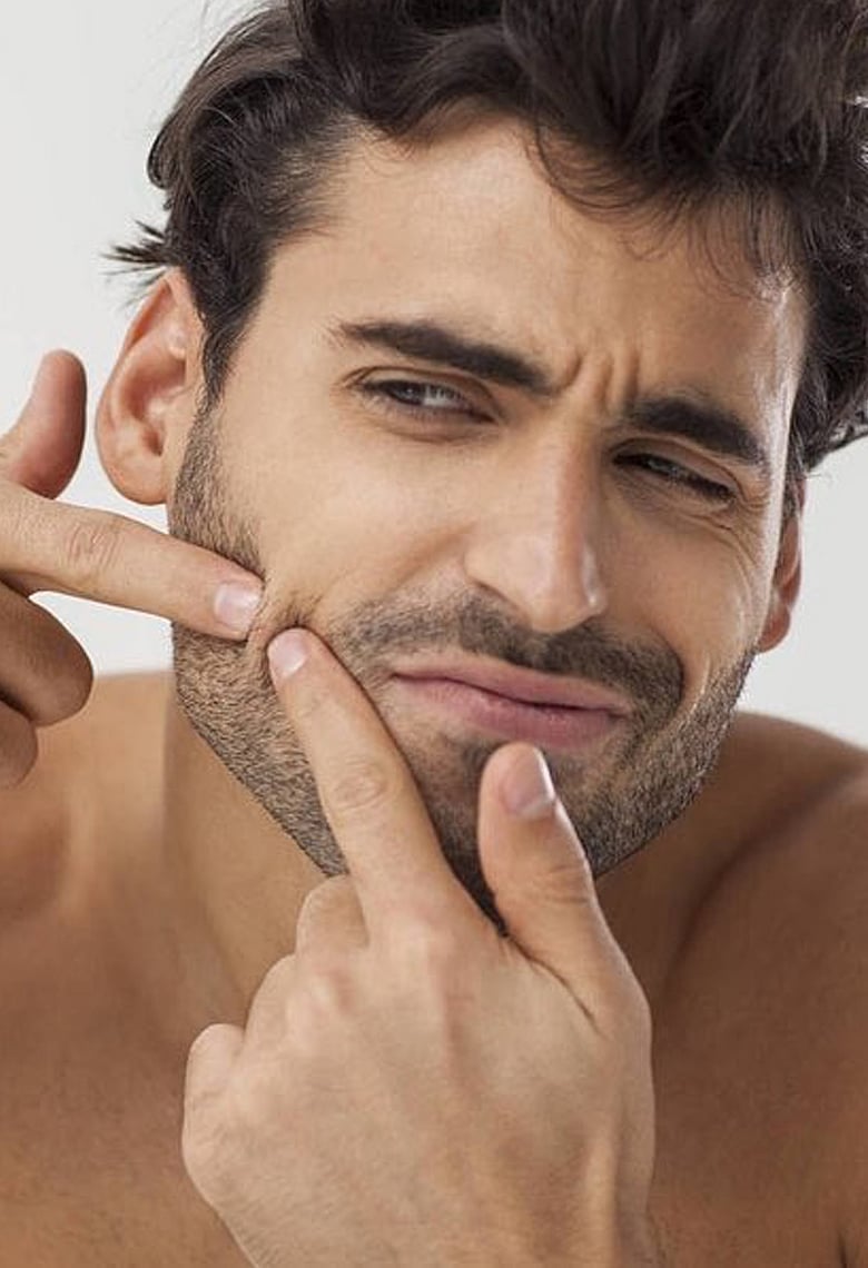 ৫টি সহজ উপায়ে ছেলেদের ব্রণের সমাধান