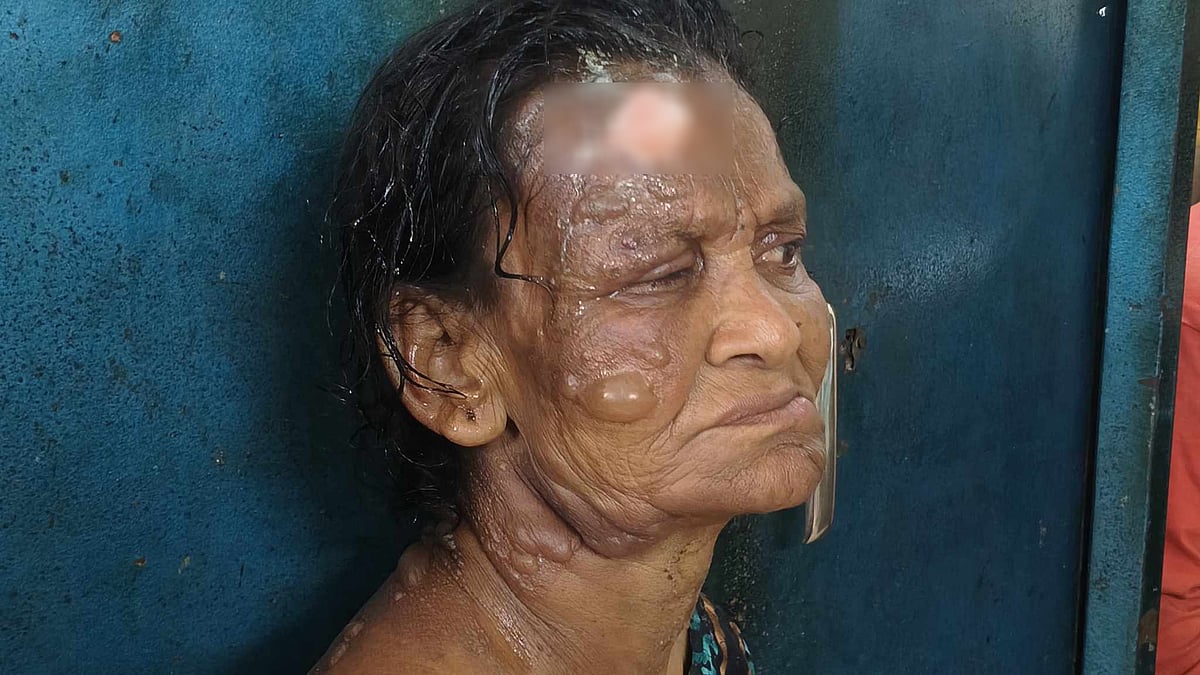 গরম পানিতে ঝলসে যাওয়া বৃদ্ধা জাহানারা বেগম। শুক্রবার কুমিল্লার মুরাদনগরে