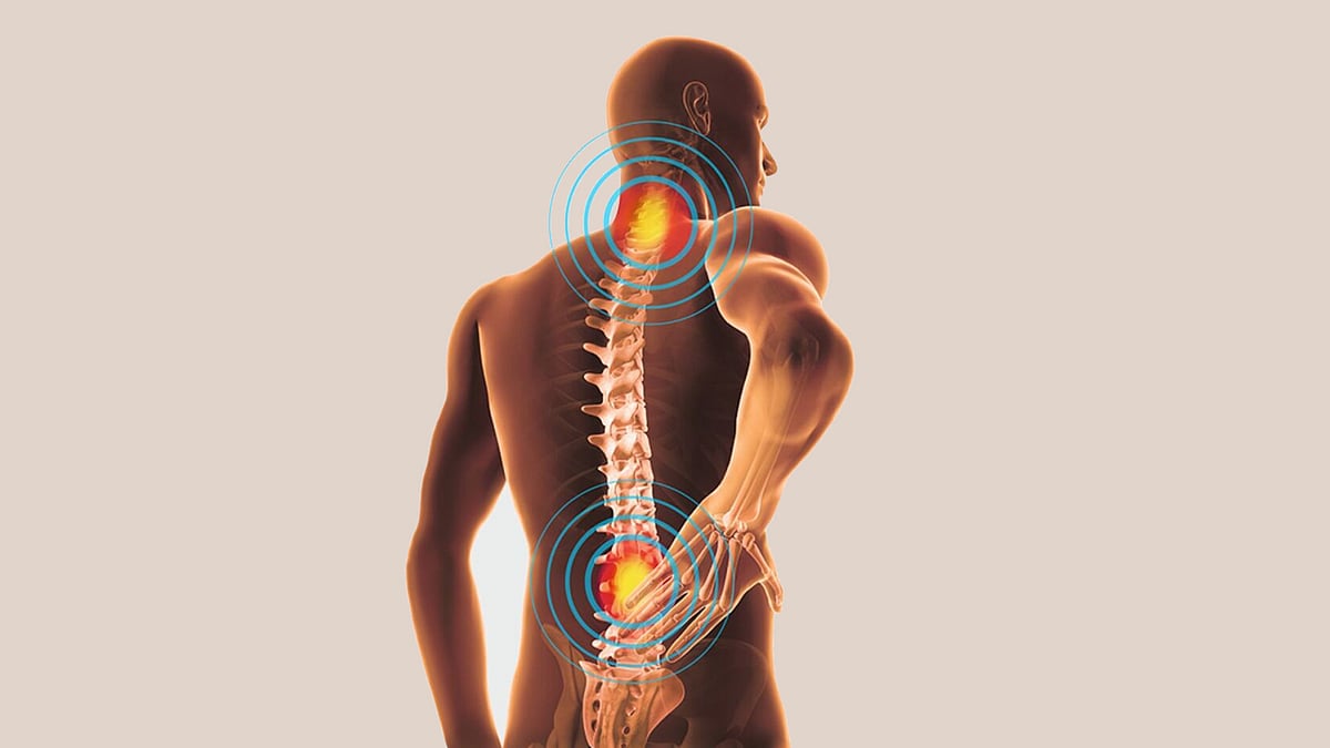 ডিস্ক প্রলাপস কেন হয়, সতর্কতা ও চিকিৎসা কী by এম ইয়াছিন আলী