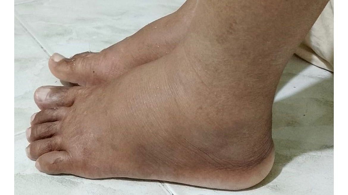 হঠাৎ পা কেন ফুলেছে?