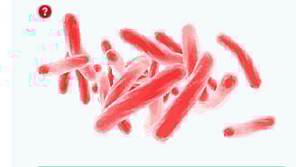 দিনাজপুরে যক্ষ্মা না থাকলেও রোগী, কফের নমুনায় জালিয়াতি