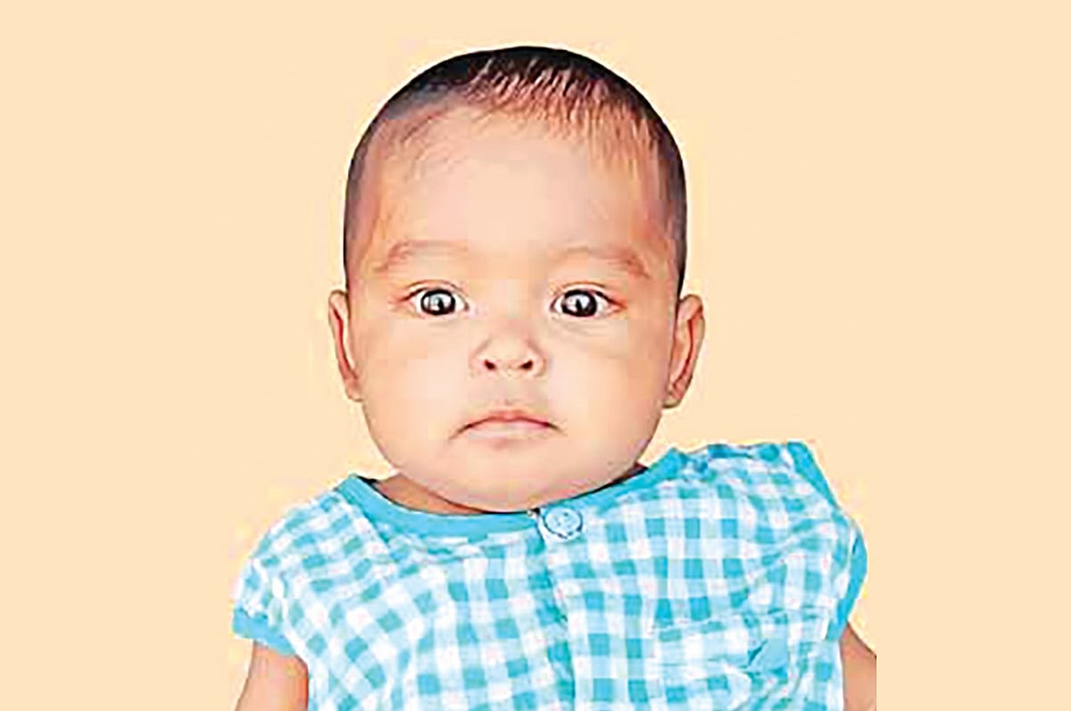 বিলিয়ারি অ্যাট্রেসিয়াতে আক্রান্ত শিশু আরহাম