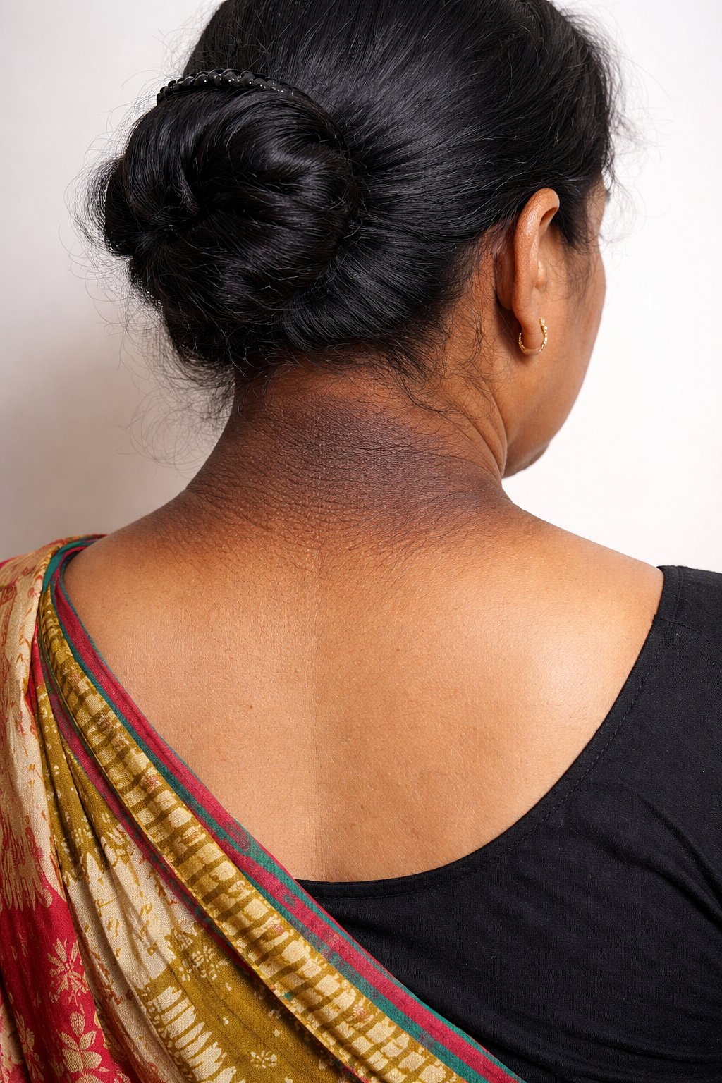 ঘাড়ের কালো দাগে যে রোগের সংকেত লুকিয়ে থাকে