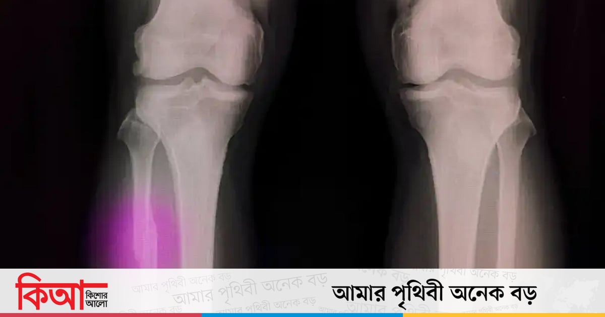 হাড় জোড়া লাগবে জাদুকরি আঠায় হাড় জোড়া লাগবে জাদুকরি আঠায়