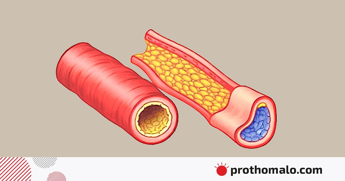 ডায়াবেটিসে ক্ষুদ্র রক্তনালির রোগ ডায়াবেটিসে ক্ষুদ্র রক্তনালির রোগ