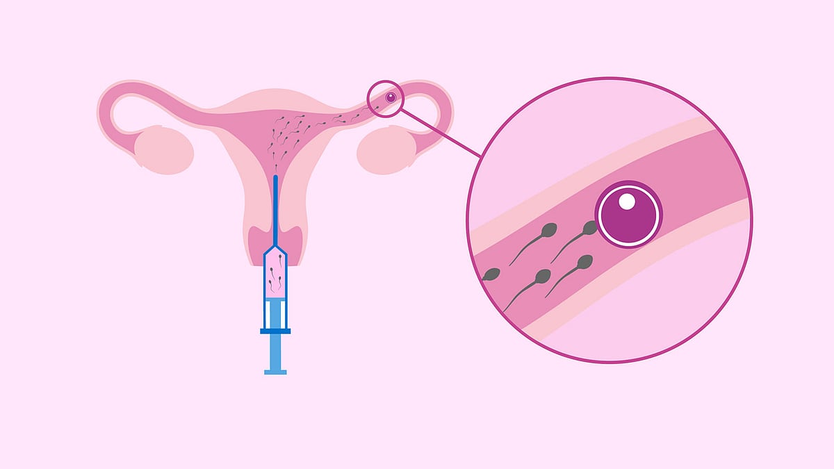 বন্ধ্যত্ব চিকিৎসায় আইইউআই, কারা এ পদ্ধতি গ্রহণ করবেন