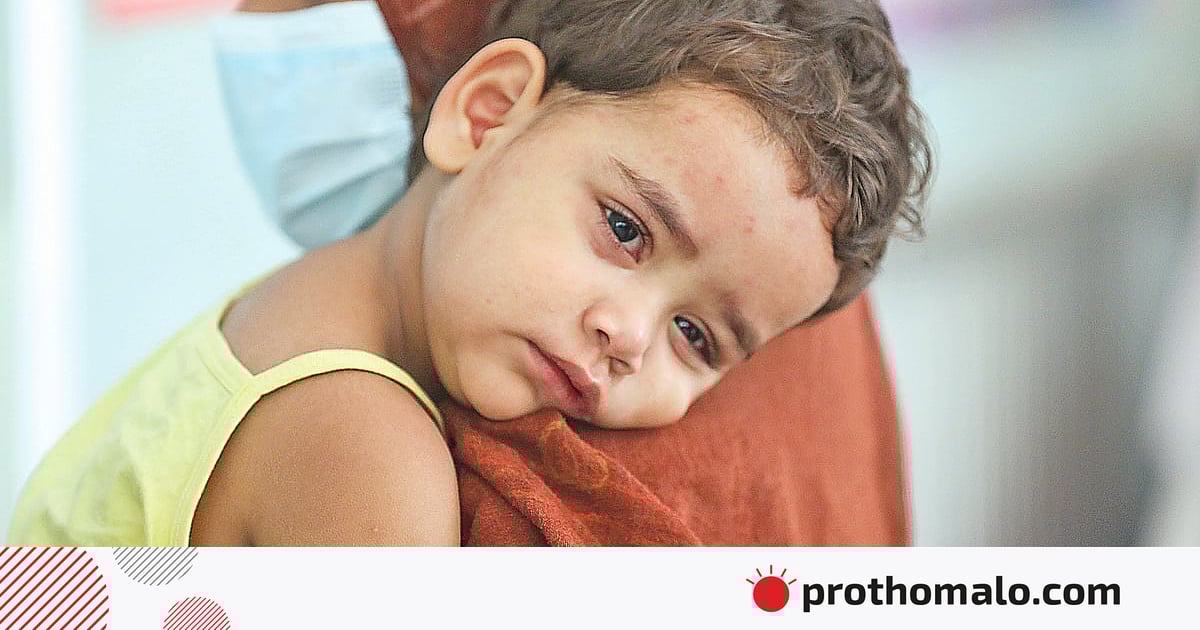 ৫৬ জেলায় হাম ছড়িয়েছে ৫৬ জেলায় হাম ছড়িয়েছে