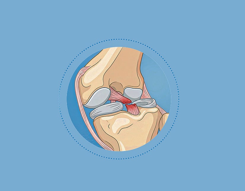 হাঁটুর লিগামেন্ট ও মেনিসকাস ছিঁড়ে গেলে কী করবেন